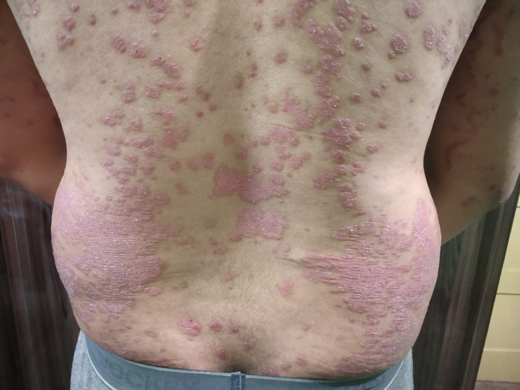 ಸೋರಿಯಾಸಿಸ್ ಚಿಕಿತ್ಸೆ psoriasis chikitse