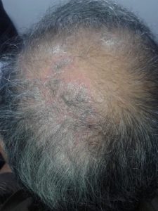 Scalp Psoriasis image