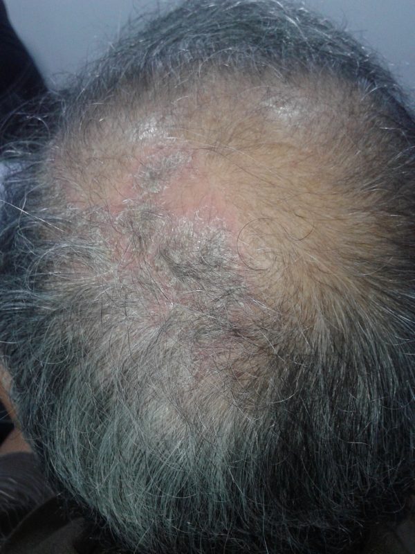 Scalp Psoriasis image