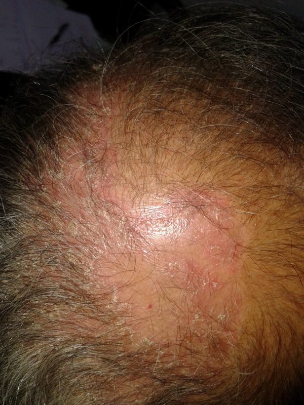 Scalp Psoriasis image