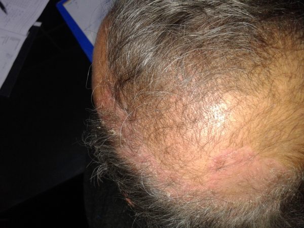 Scalp Psoriasis Treatment