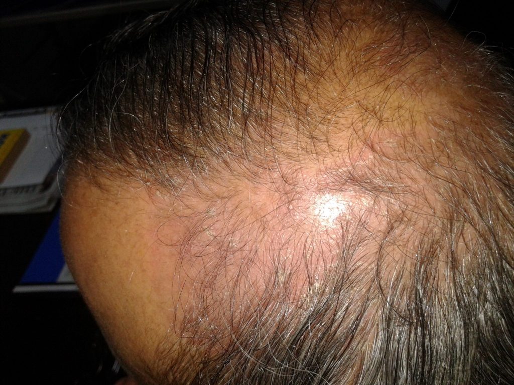 Scalp Psoriasis Treatment