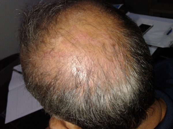 Scalp Psoriasis image