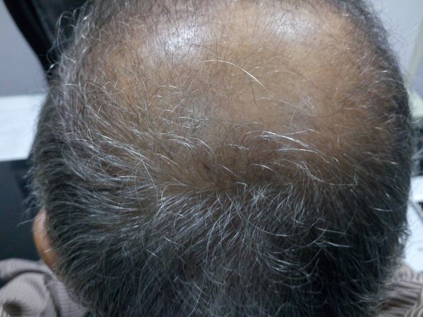 Scalp Psoriasis image