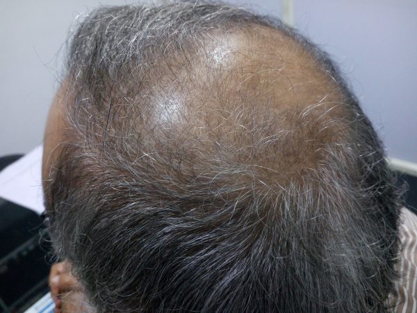 Scalp Psoriasis Treatment