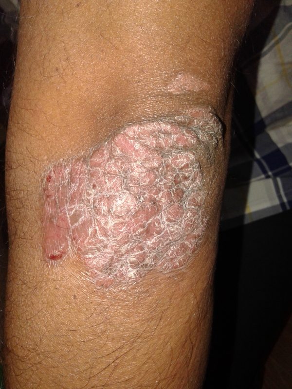 Psoriasis Case Study - 1