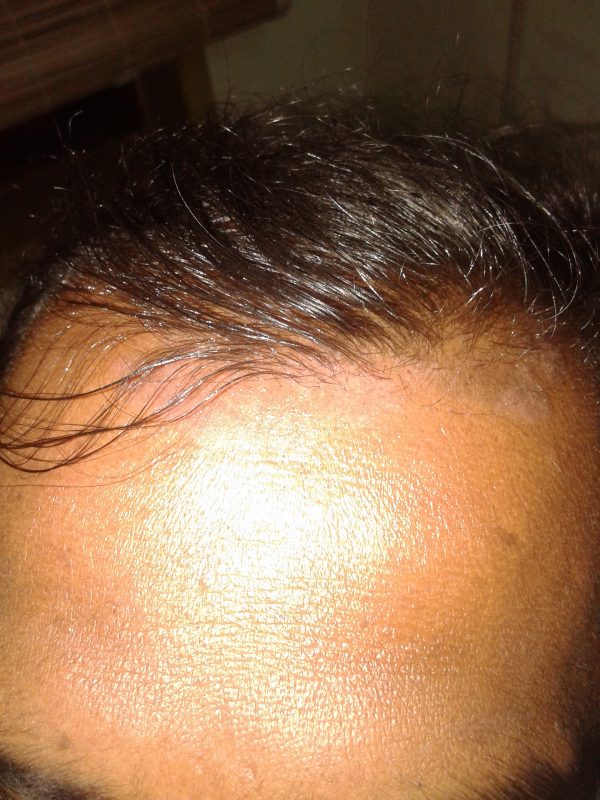 Scalp Psoriasis image