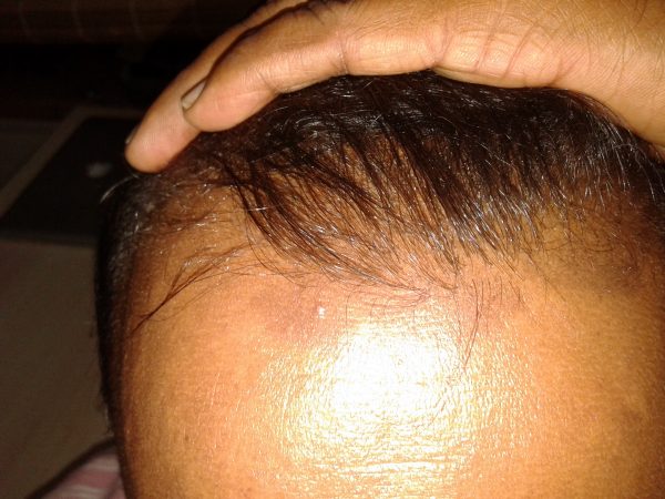 Scalp Psoriasis image