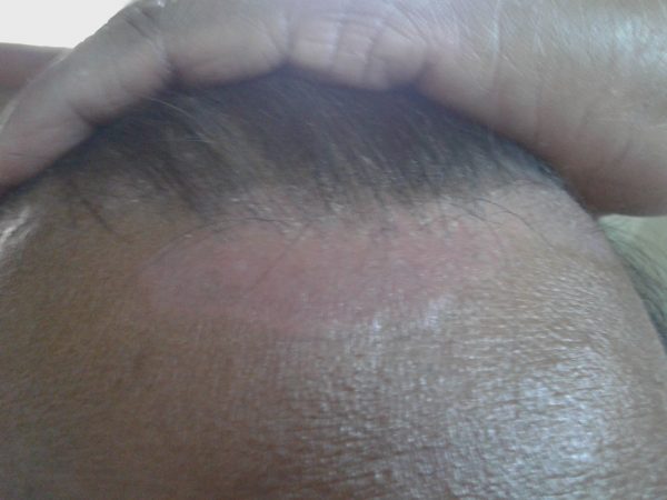 Scalp Psoriasis image