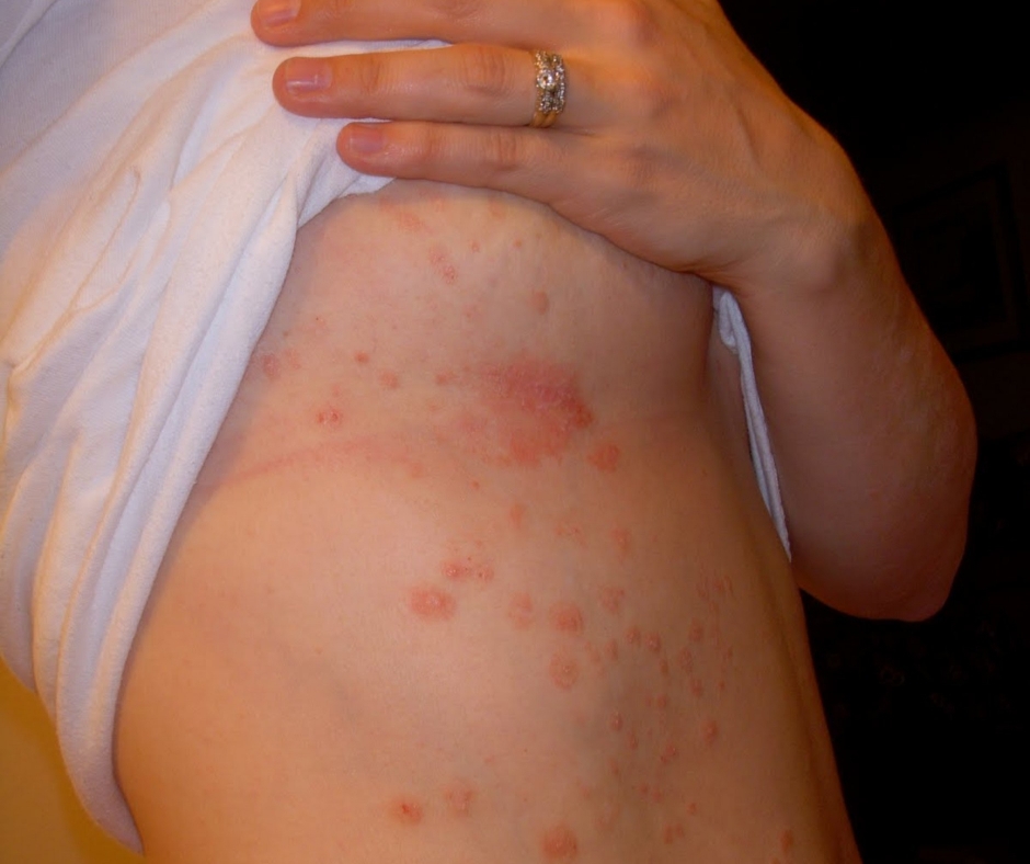 inverse psoriasis
