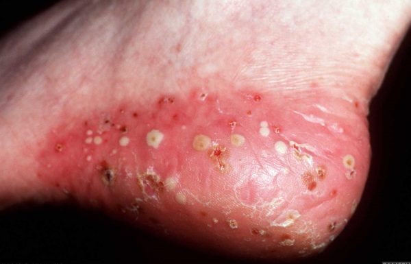 pustular psoriasis