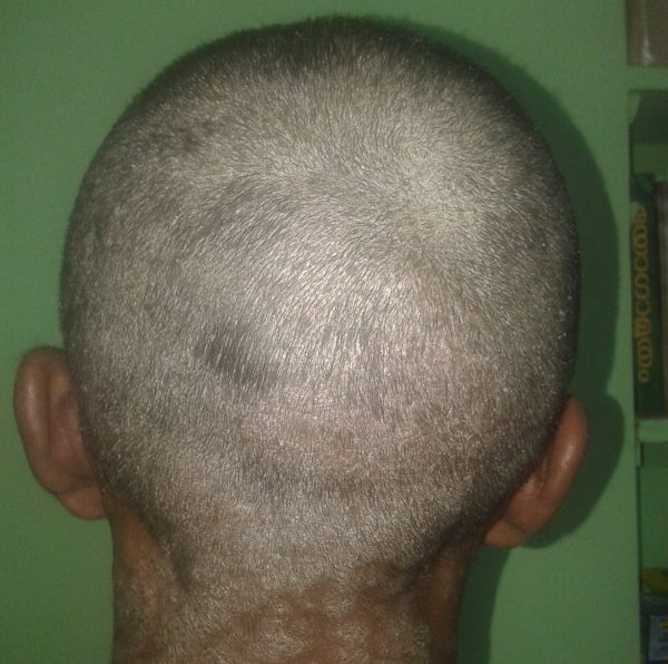 Scalp Psoriasis image