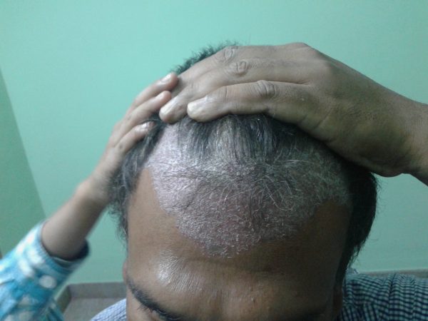 Scalp psoriasis image