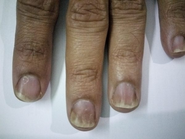 Nail Psoriasis image