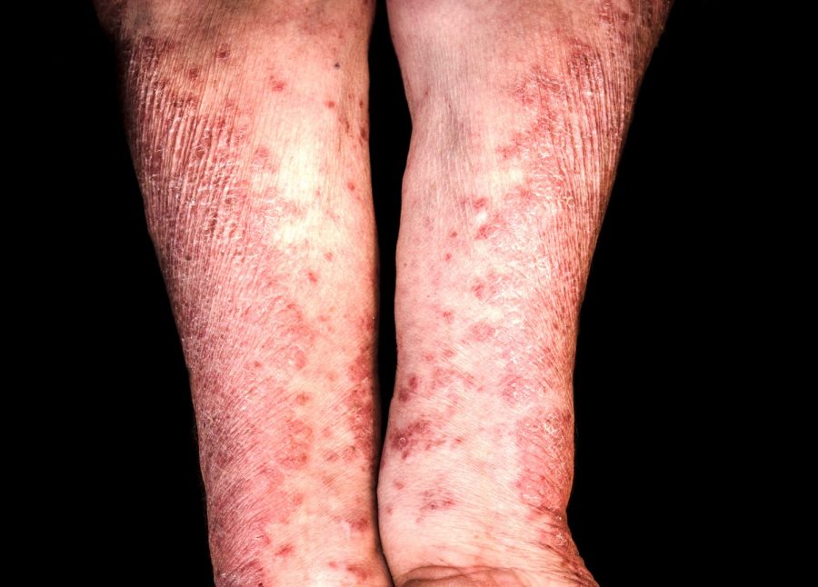 Erythrodermic psoriasis