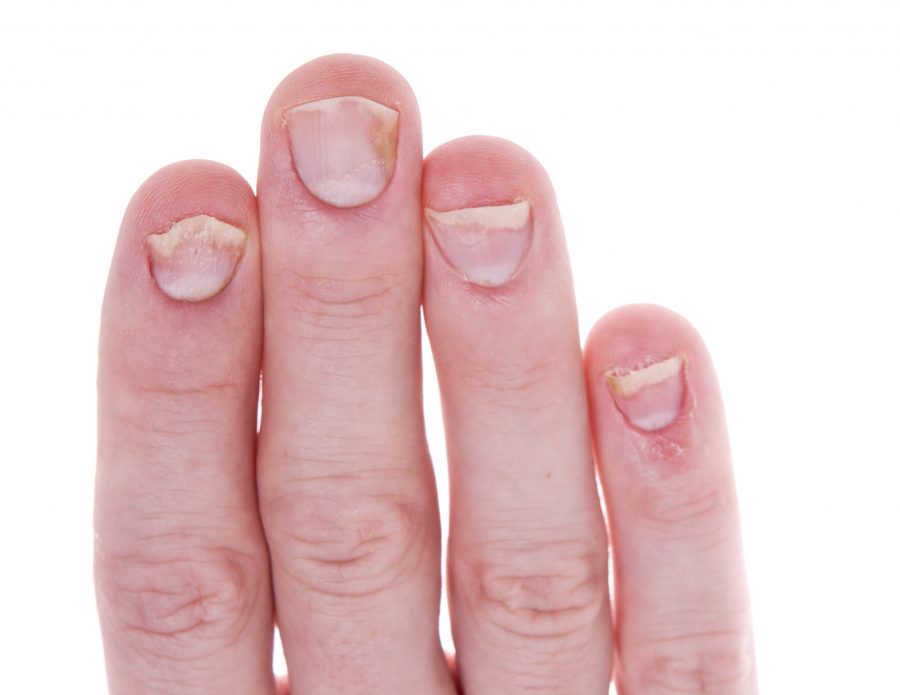 Nail Psoriasis Image