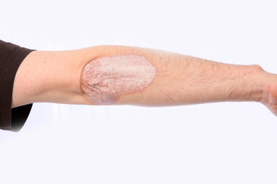 Plaque Psoriasis image