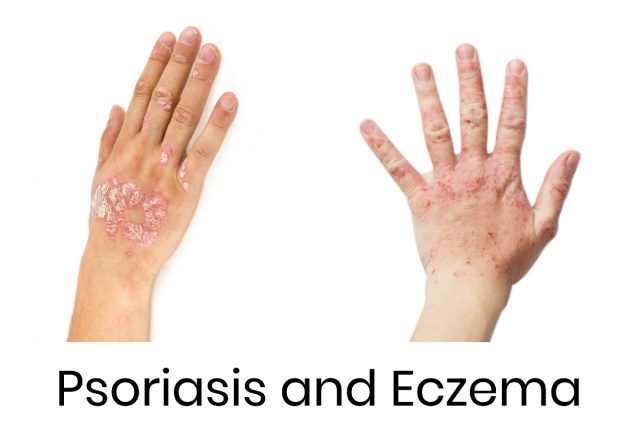 Eczema and Psoriasis