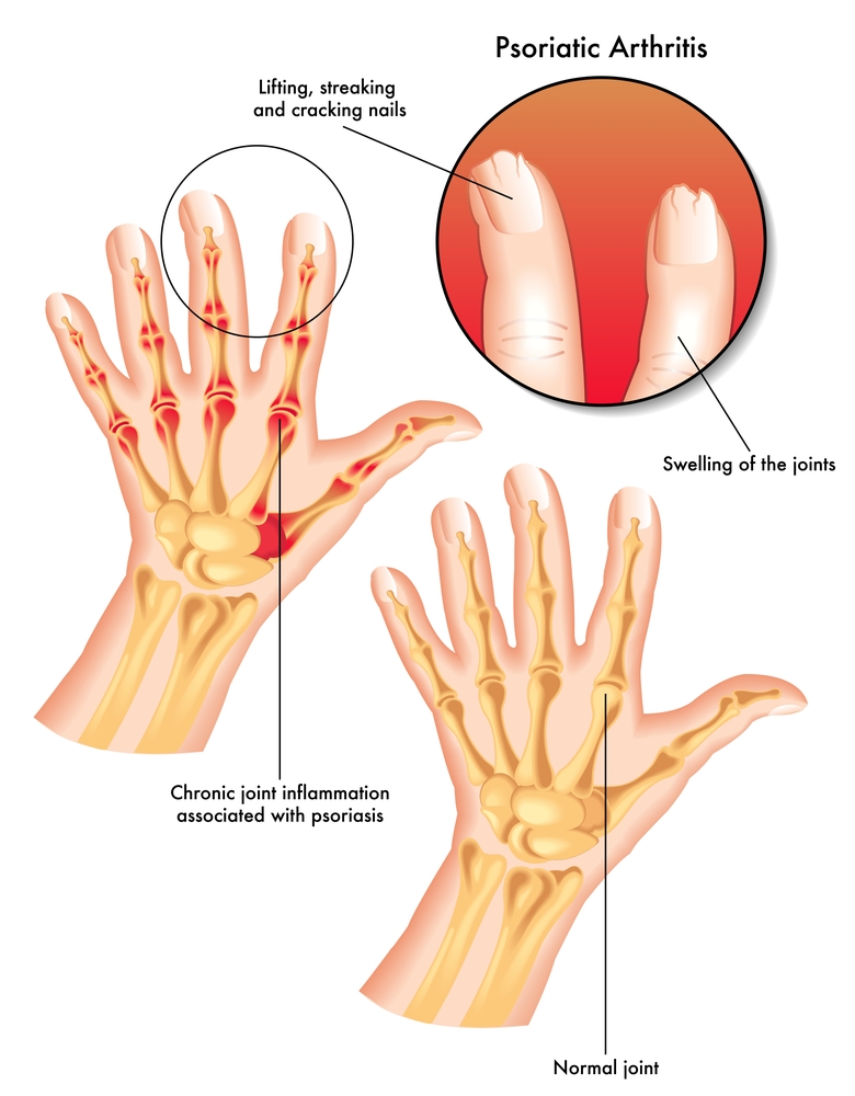 Psoriatic Arthritis and Ayurvedic Treatment