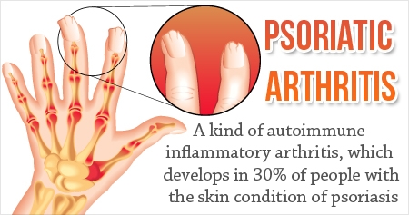 Psoriatic Arthritis