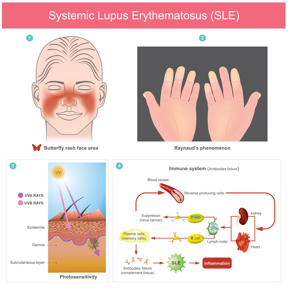 Systemic Lupus Erythematosus (SLE)