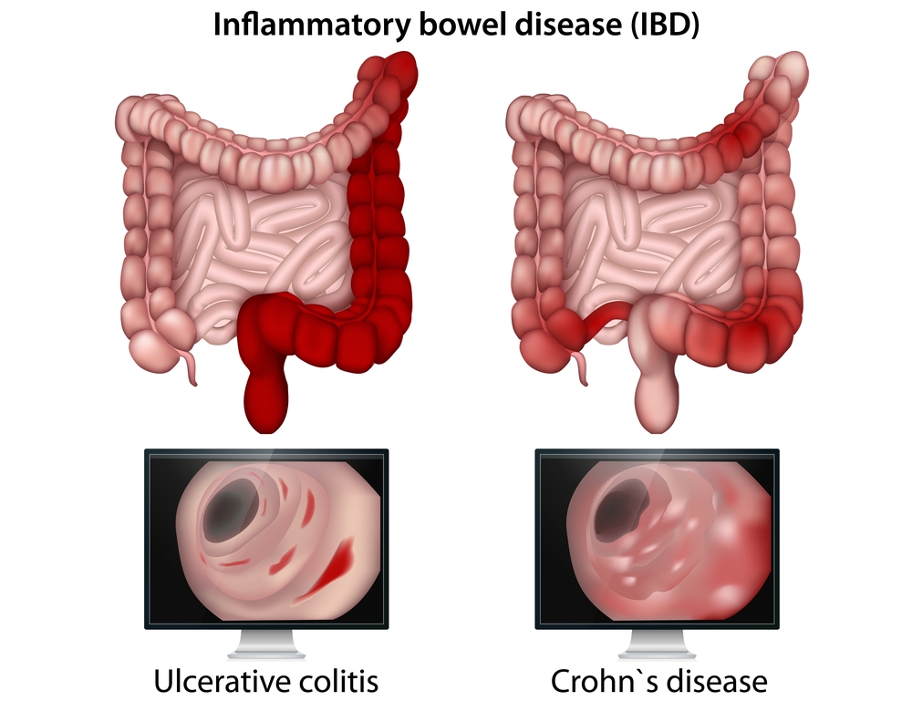 Ilammatory Bowel Disease