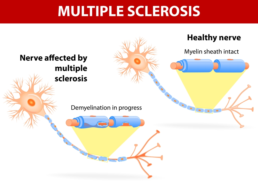 multiple sclerosis