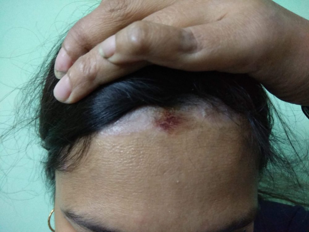 Scalp Psoriasis