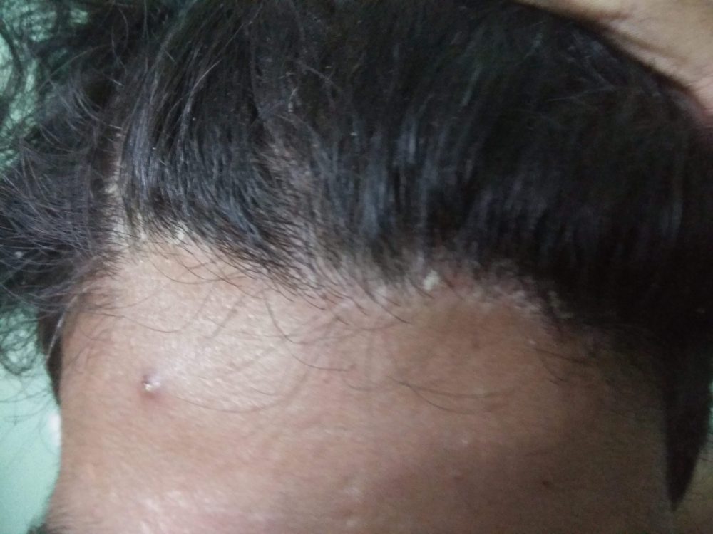 scalp psoriasis treatment