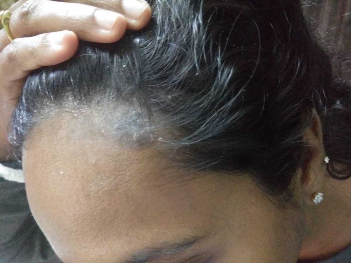 Scalp Psoriasis Treatment
