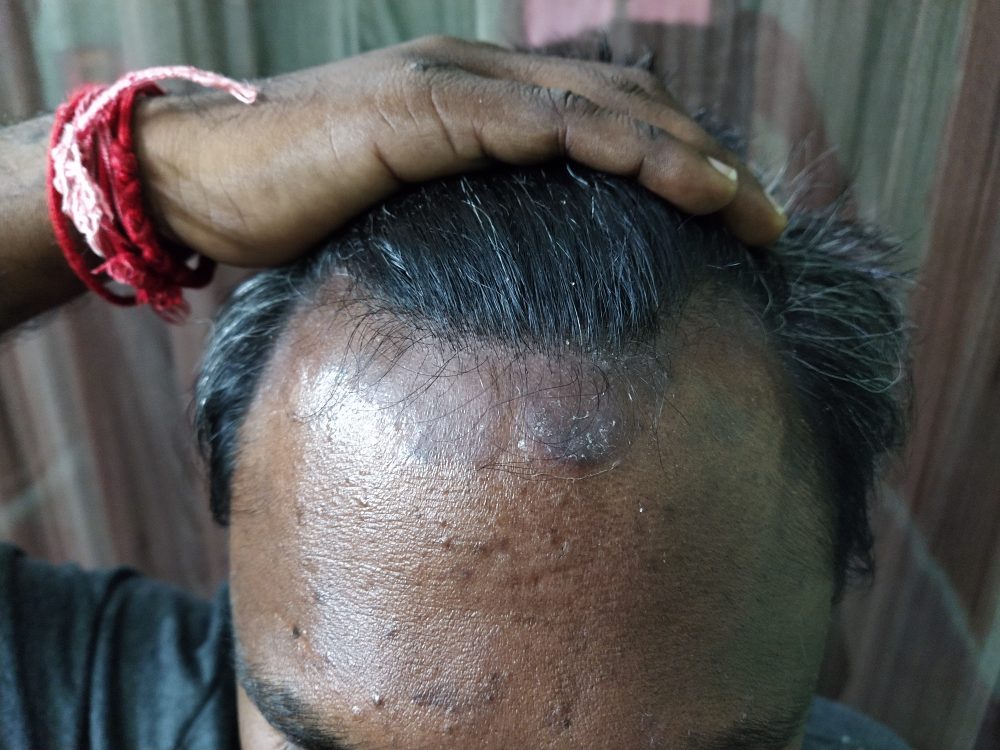Scalp Psoriasis Ayurvedic Treatment