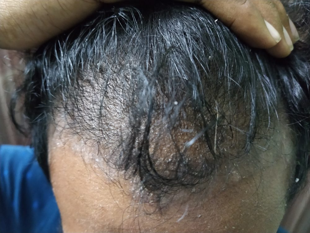 Symptoms od Scalp Psoriasis