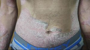 psoriasis cure Ayurveda