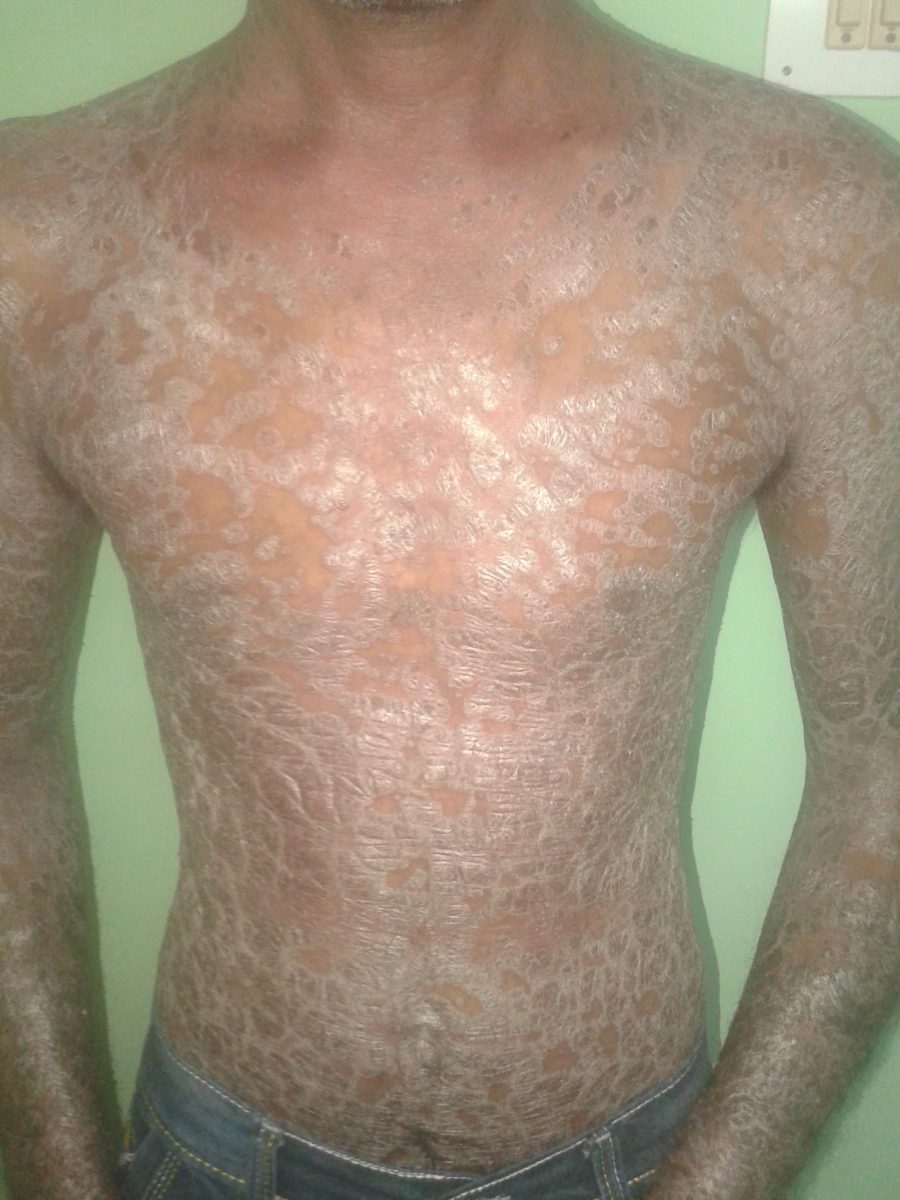 Plaque psoriasis