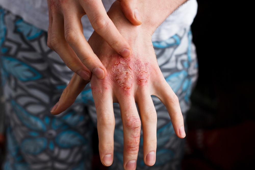 Eczema, or atopic dermatitis