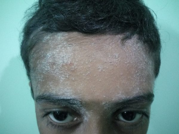Facial Psoriasis