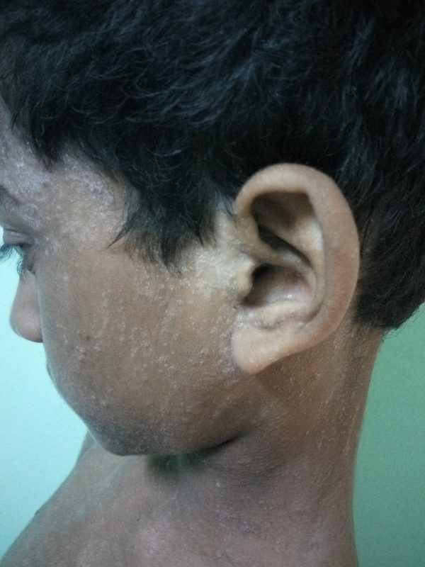 Psoriasis in Face
