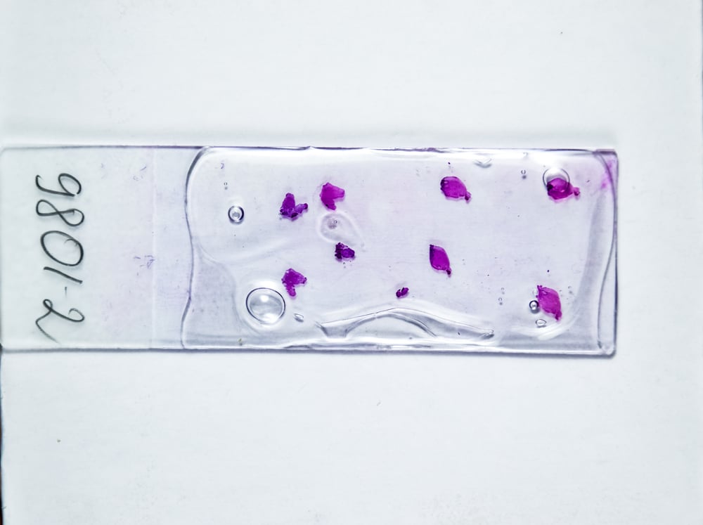 Skin Biopsy for Psoriasis
