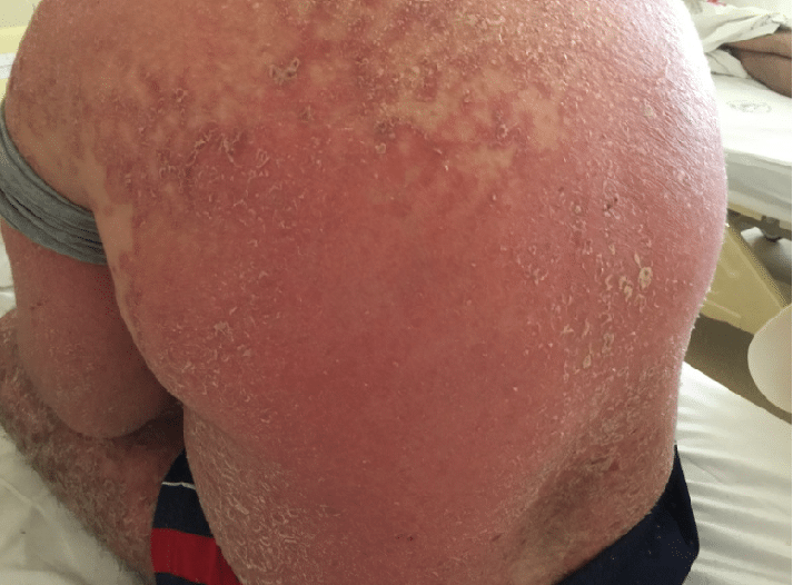 Erythrodermic-psoriasis