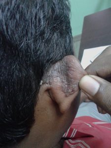 Psoriasis behind the ear treatment