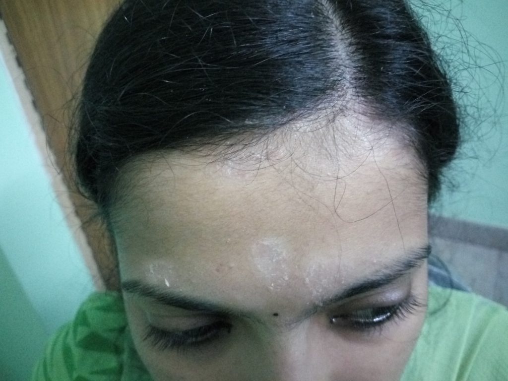 Scalp Psoriasis