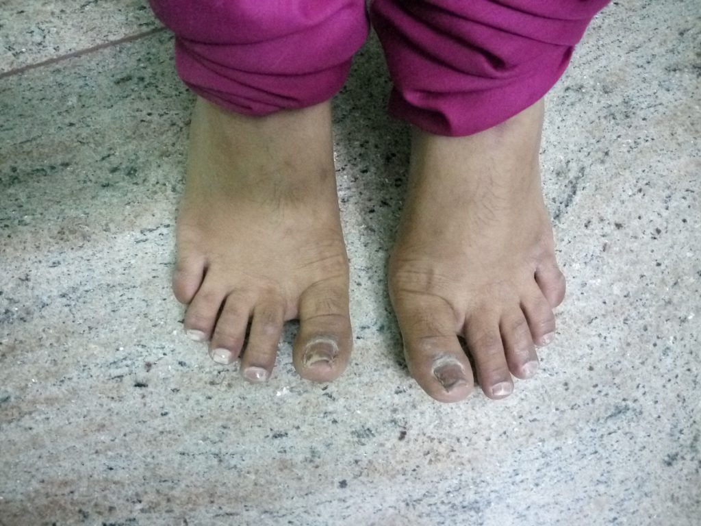 Nail Psoriasis