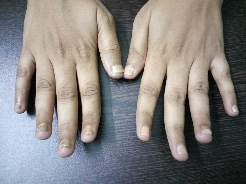 Nail Psoriasis