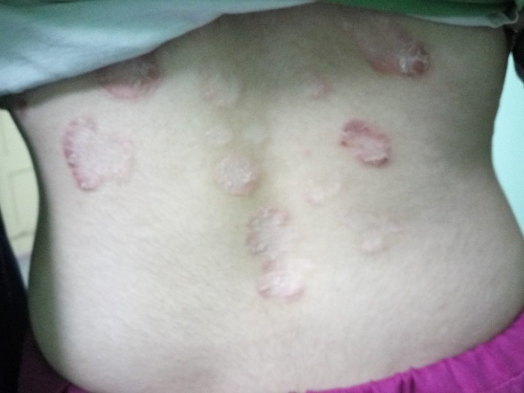 Plaque Psoriasis