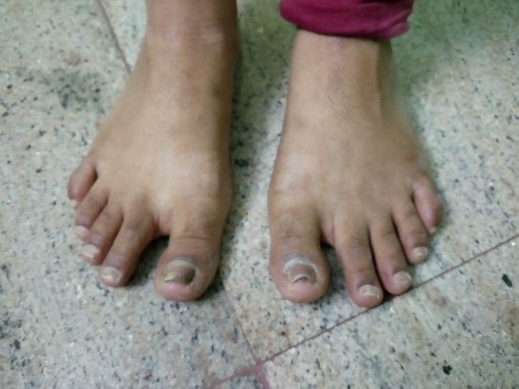 Nail Psoriasis