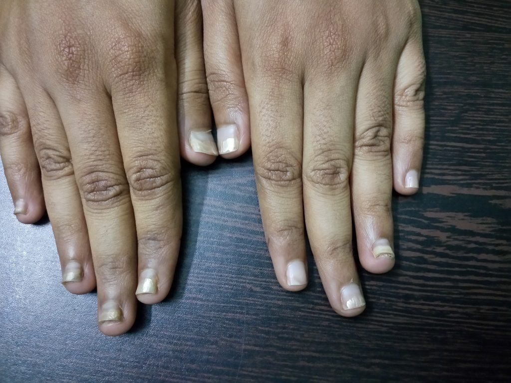 Nail Psoriasis