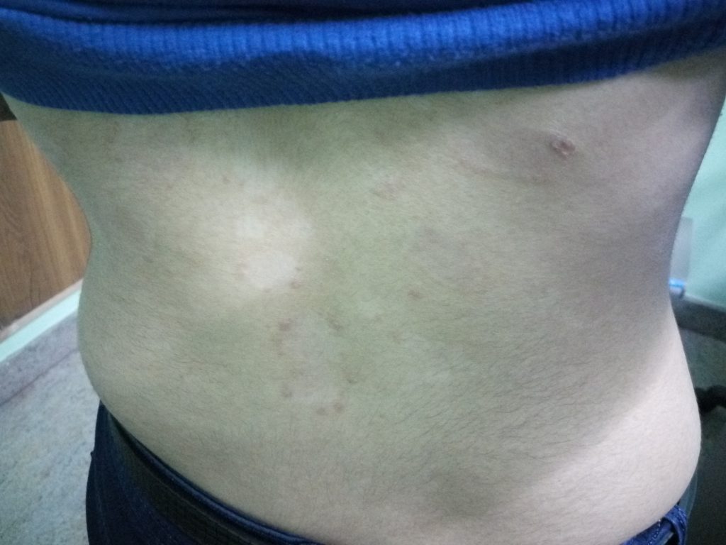 Plaque Psoriasis