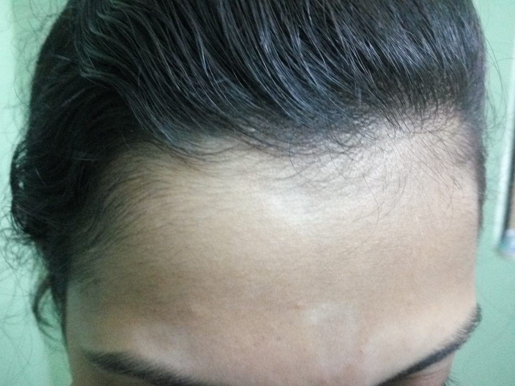 Scalp Psoriasis