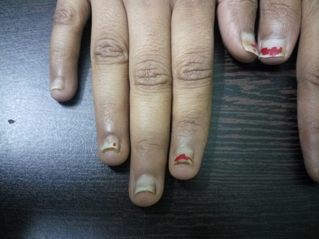 Nail Psoriasis