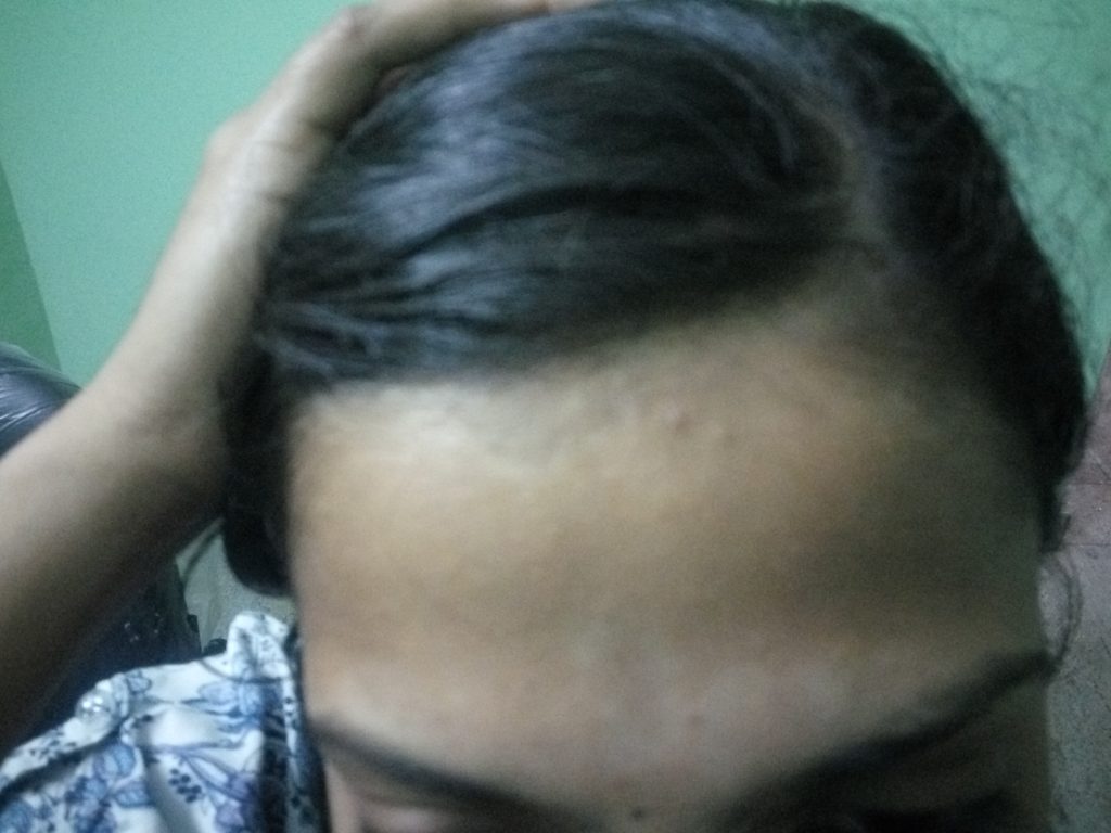 Scalp Psoriasis